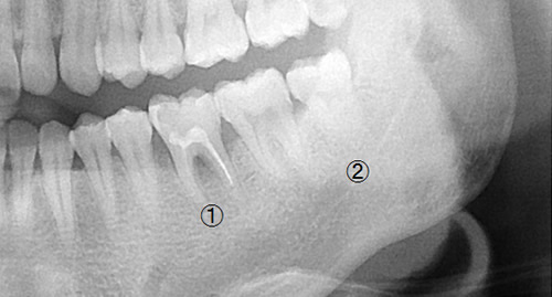 抜歯前のレントゲン